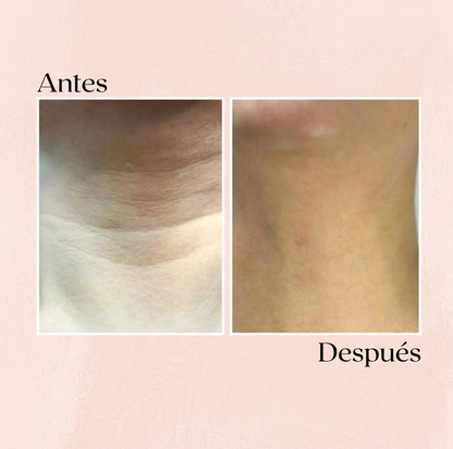 Sistema de Micro-Infusión Facial: Tu tratamiento de clínica en casa