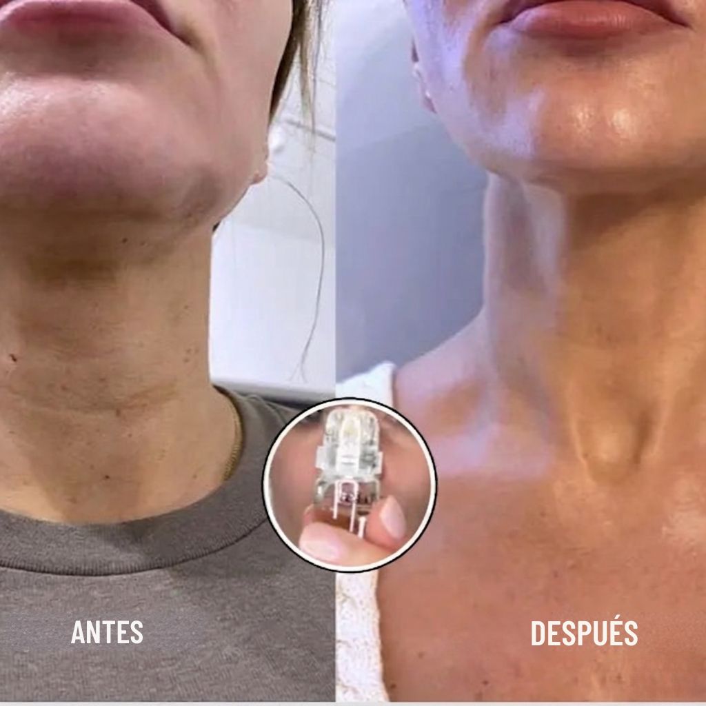 Sistema de Micro-Infusión Facial: Tu tratamiento de clínica en casa