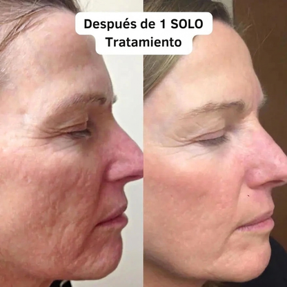 Sistema de Micro-Infusión Facial: Tu tratamiento de clínica en casa