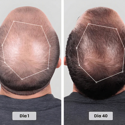 Gorra de Fototerapia Capilar